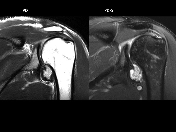 Figure 3 for case tendon of long head of biceps brachii ( RID1944 )